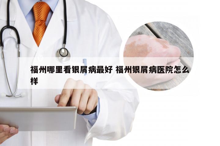 福州哪里看银屑病最好 福州银屑病医院怎么样