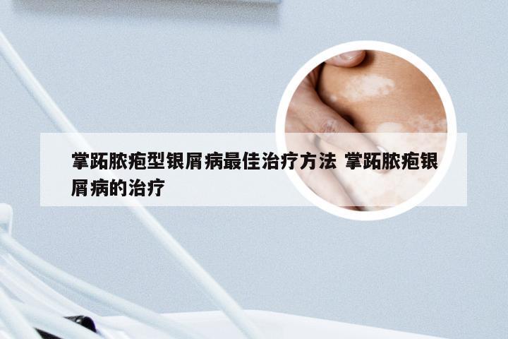 掌跖脓疱型银屑病最佳治疗方法 掌跖脓疱银屑病的治疗