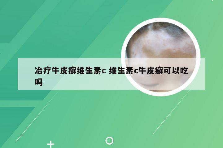 冶疗牛皮癣维生素c 维生素c牛皮癣可以吃吗