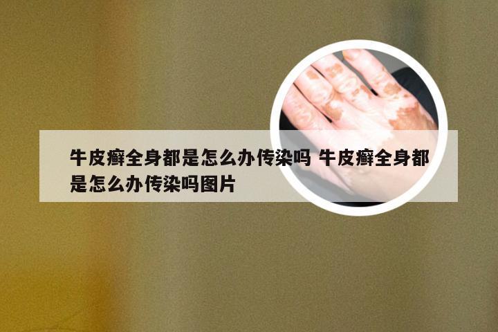 牛皮癣全身都是怎么办传染吗 牛皮癣全身都是怎么办传染吗图片