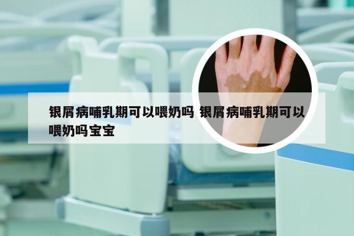 银屑病哺乳期可以喂奶吗 银屑病哺乳期可以喂奶吗宝宝