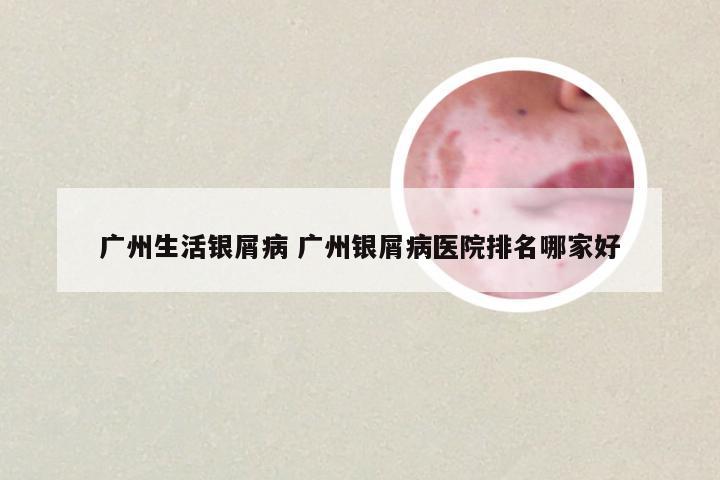 广州生活银屑病 广州银屑病医院排名哪家好