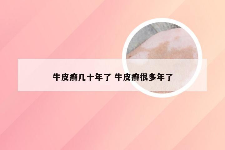 牛皮癣几十年了 牛皮癣很多年了