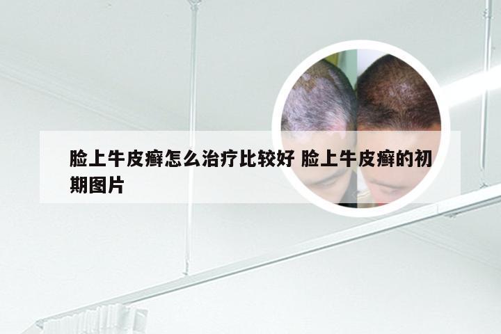 脸上牛皮癣怎么治疗比较好 脸上牛皮癣的初期图片