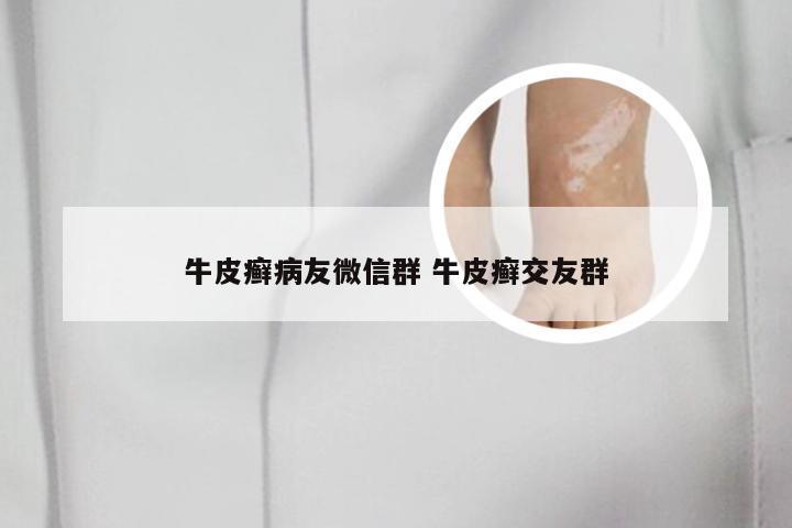 牛皮癣病友微信群 牛皮癣交友群