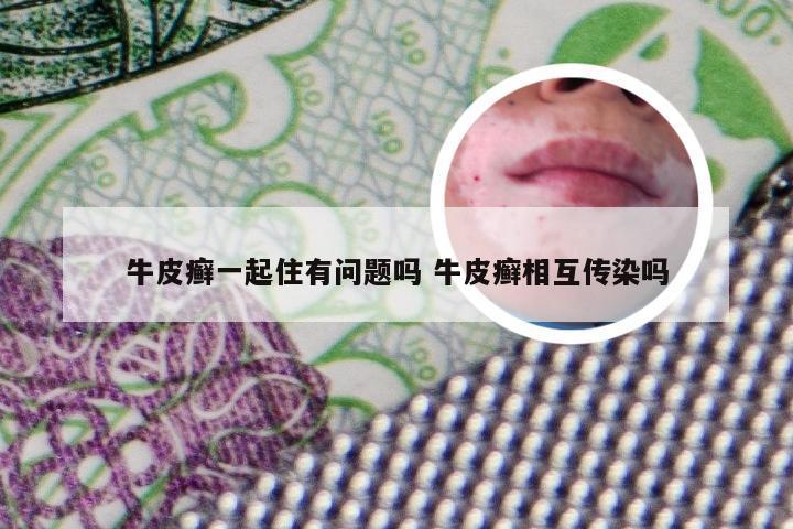 牛皮癣一起住有问题吗 牛皮癣相互传染吗