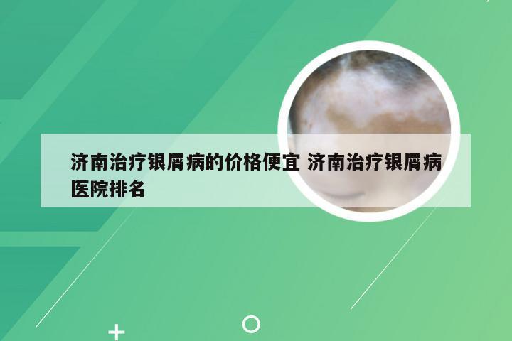 济南治疗银屑病的价格便宜 济南治疗银屑病医院排名