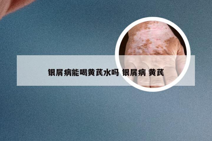 银屑病能喝黄芪水吗 银屑病 黄芪
