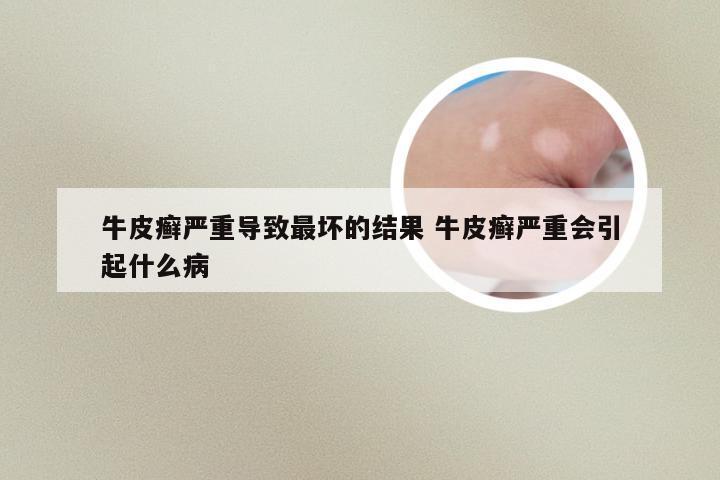 牛皮癣严重导致最坏的结果 牛皮癣严重会引起什么病