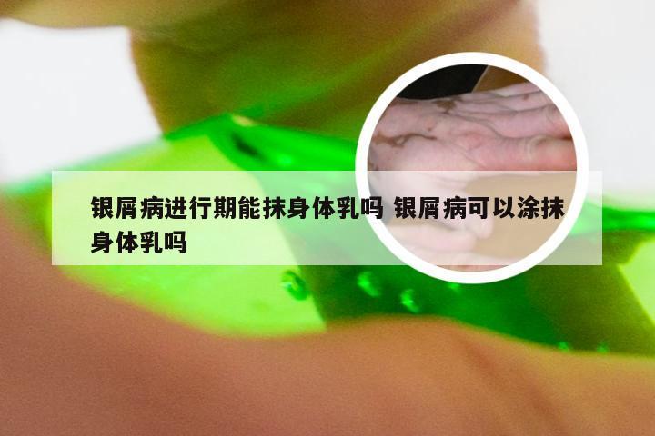 银屑病进行期能抹身体乳吗 银屑病可以涂抹身体乳吗
