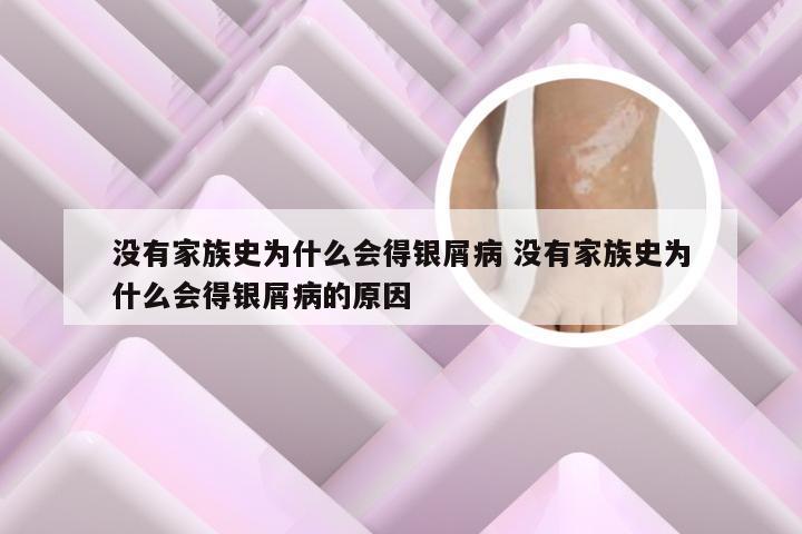 没有家族史为什么会得银屑病 没有家族史为什么会得银屑病的原因