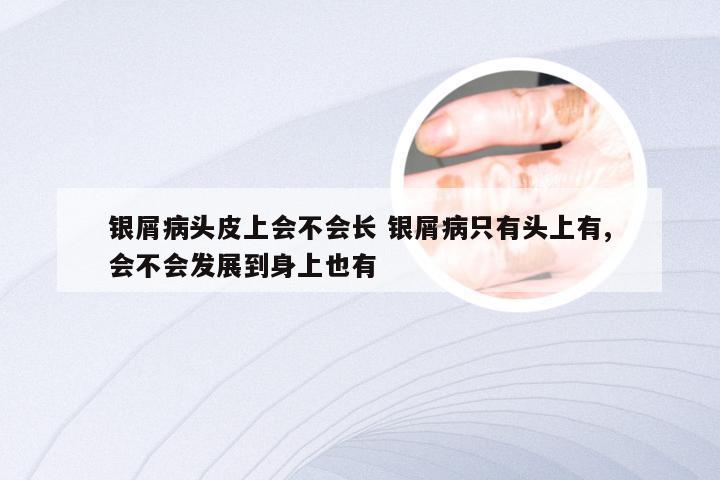 银屑病头皮上会不会长 银屑病只有头上有,会不会发展到身上也有