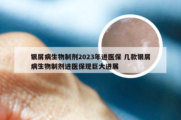 银屑病生物制剂2023年进医保 几款银屑病生物制剂进医保现巨大进展