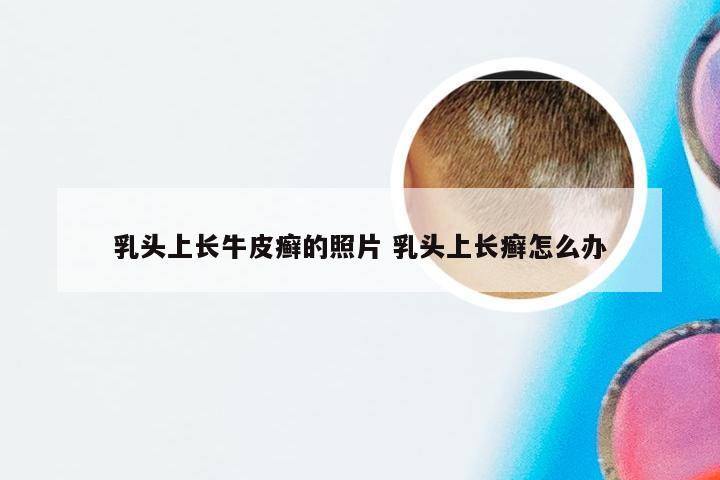 乳头上长牛皮癣的照片 乳头上长癣怎么办