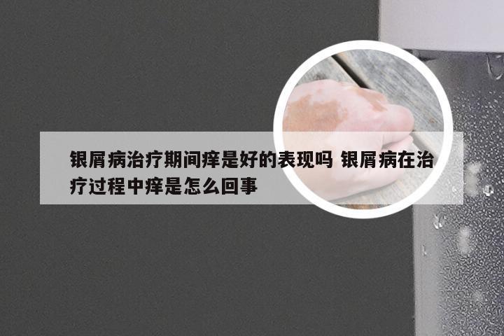 银屑病治疗期间痒是好的表现吗 银屑病在治疗过程中痒是怎么回事