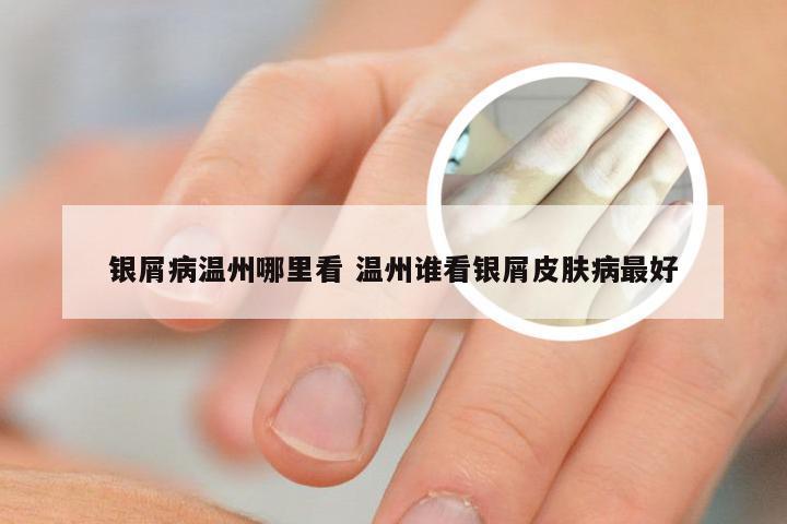 银屑病温州哪里看 温州谁看银屑皮肤病最好