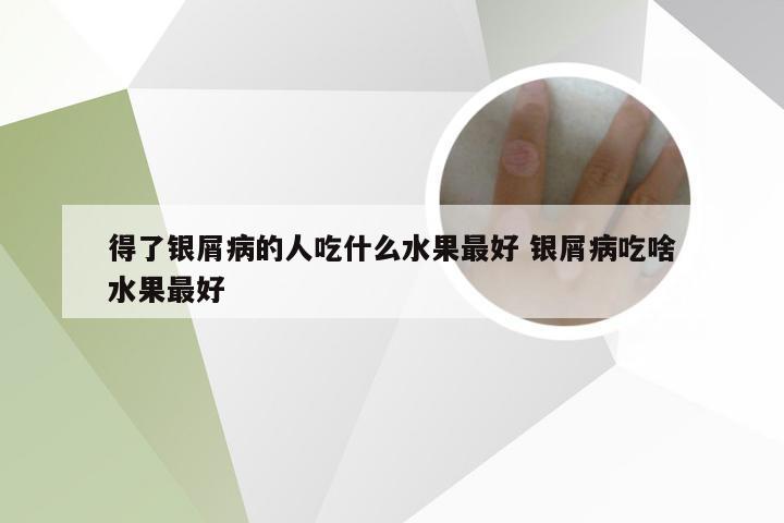 得了银屑病的人吃什么水果最好 银屑病吃啥水果最好
