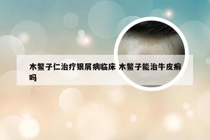 木鳖子仁治疗银屑病临床 木鳖子能治牛皮癣吗