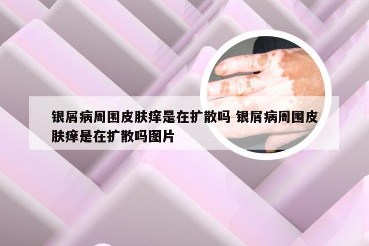 银屑病周围皮肤痒是在扩散吗 银屑病周围皮肤痒是在扩散吗图片