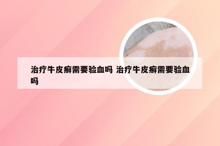 治疗牛皮癣需要验血吗 治疗牛皮癣需要验血吗