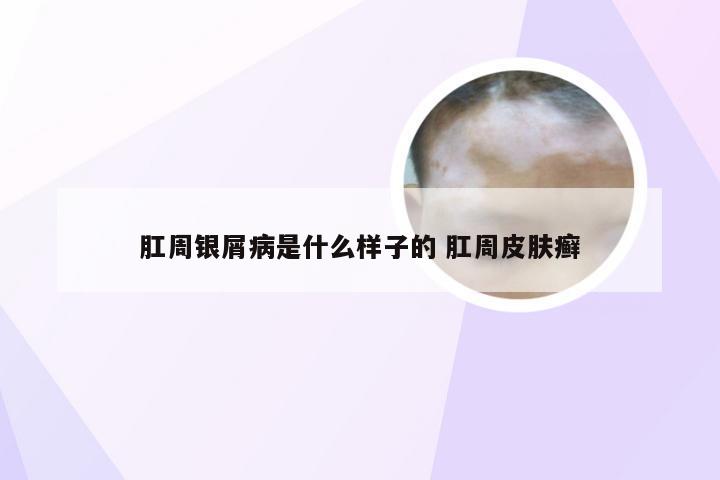 肛周银屑病是什么样子的 肛周皮肤癣