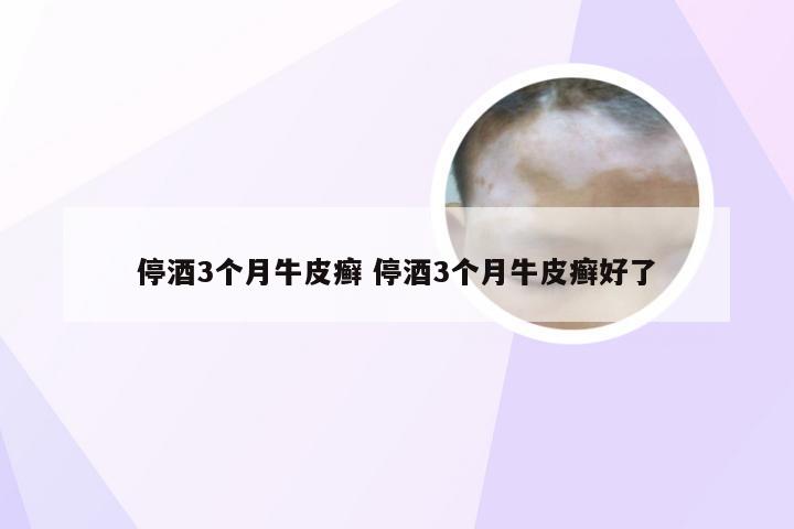 停酒3个月牛皮癣 停酒3个月牛皮癣好了