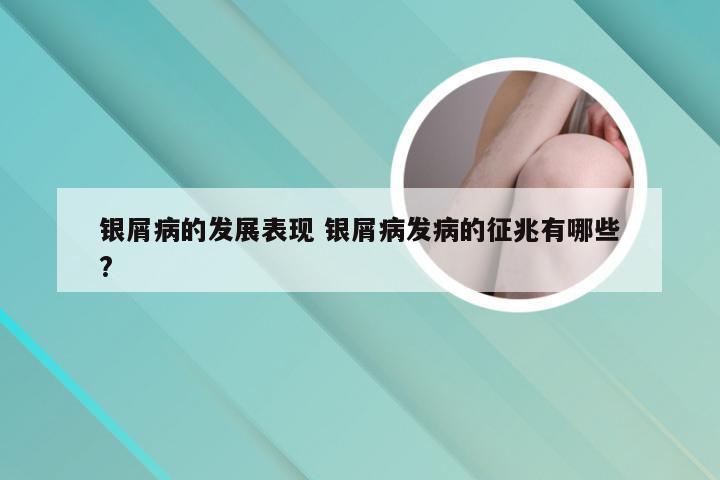 银屑病的发展表现 银屑病发病的征兆有哪些?