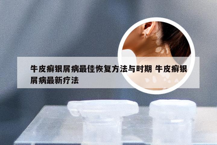 牛皮癣银屑病最佳恢复方法与时期 牛皮癣银屑病最新疗法