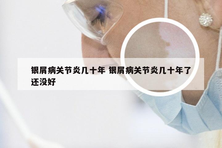 银屑病关节炎几十年 银屑病关节炎几十年了还没好