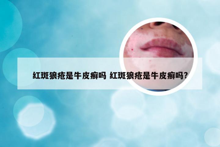 红斑狼疮是牛皮癣吗 红斑狼疮是牛皮癣吗?