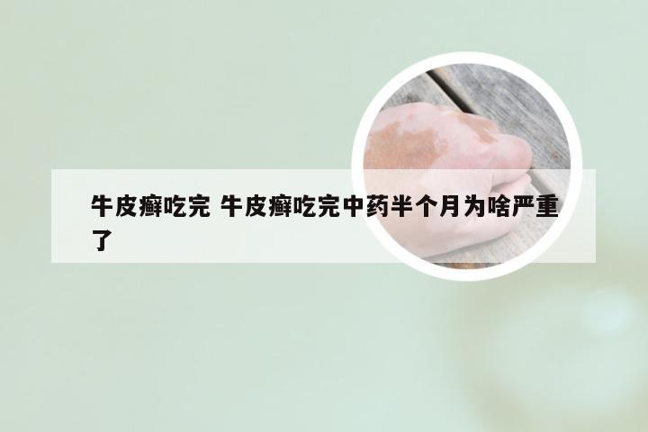 牛皮癣吃完 牛皮癣吃完中药半个月为啥严重了
