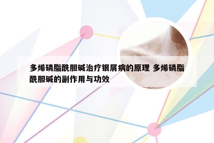 多烯磷脂酰胆碱治疗银屑病的原理 多烯磷脂酰胆碱的副作用与功效