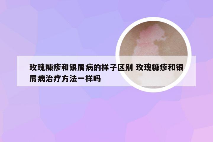 玫瑰糠疹和银屑病的样子区别 玫瑰糠疹和银屑病治疗方法一样吗