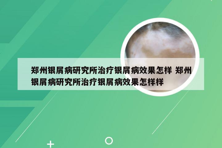 郑州银屑病研究所治疗银屑病效果怎样 郑州银屑病研究所治疗银屑病效果怎样样