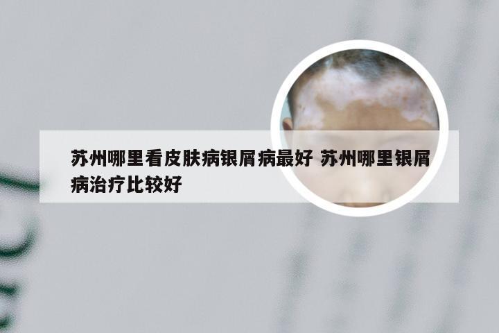 苏州哪里看皮肤病银屑病最好 苏州哪里银屑病治疗比较好