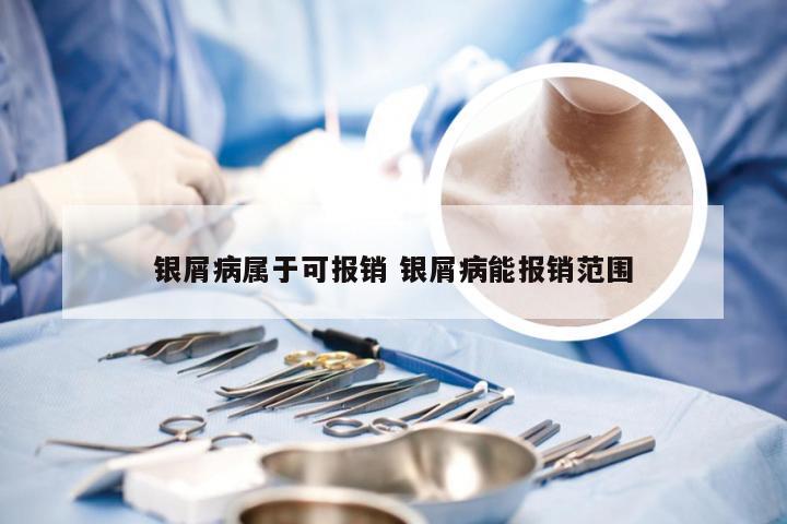 银屑病属于可报销 银屑病能报销范围