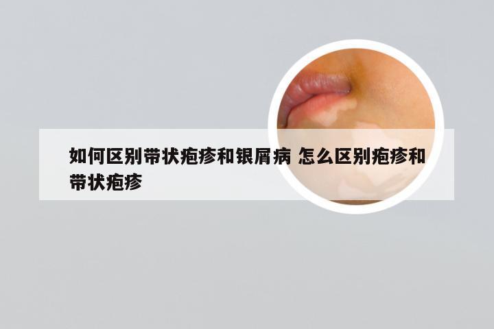 如何区别带状疱疹和银屑病 怎么区别疱疹和带状疱疹