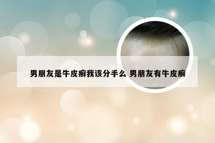 男朋友是牛皮癣我该分手么 男朋友有牛皮癣