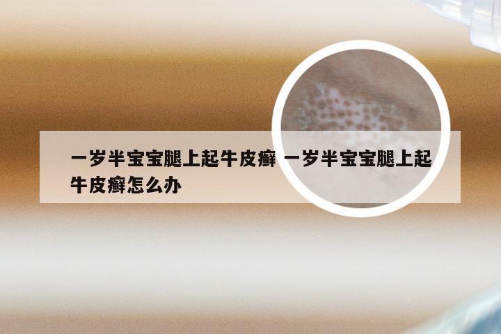 一岁半宝宝腿上起牛皮癣 一岁半宝宝腿上起牛皮癣怎么办