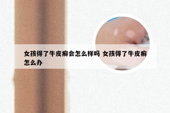 女孩得了牛皮癣会怎么样吗 女孩得了牛皮癣怎么办