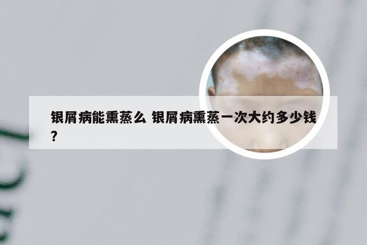 银屑病能熏蒸么 银屑病熏蒸一次大约多少钱?