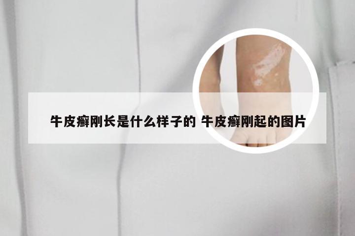 牛皮癣刚长是什么样子的 牛皮癣刚起的图片