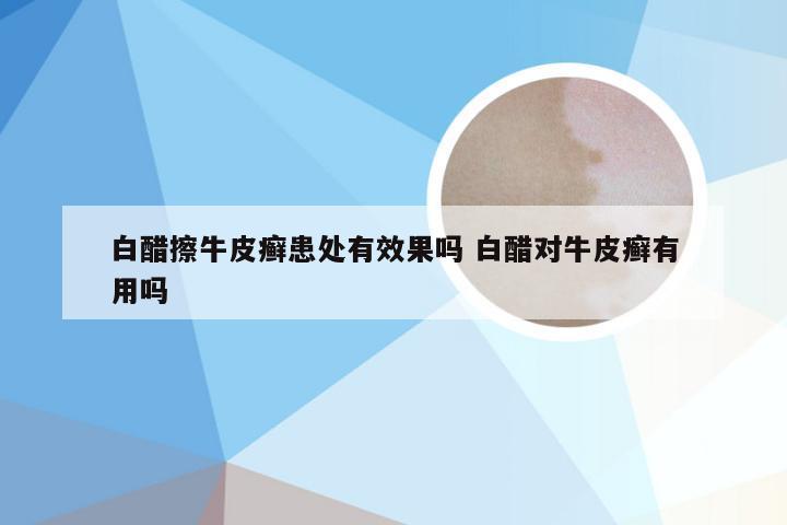 白醋擦牛皮癣患处有效果吗 白醋对牛皮癣有用吗