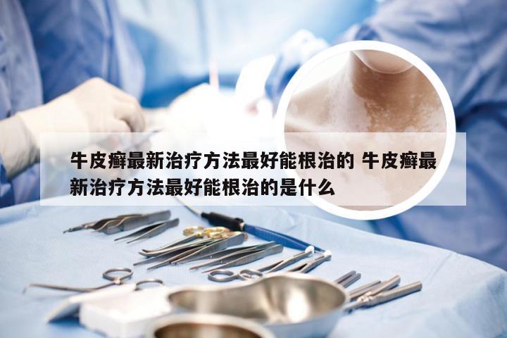 牛皮癣最新治疗方法最好能根治的 牛皮癣最新治疗方法最好能根治的是什么