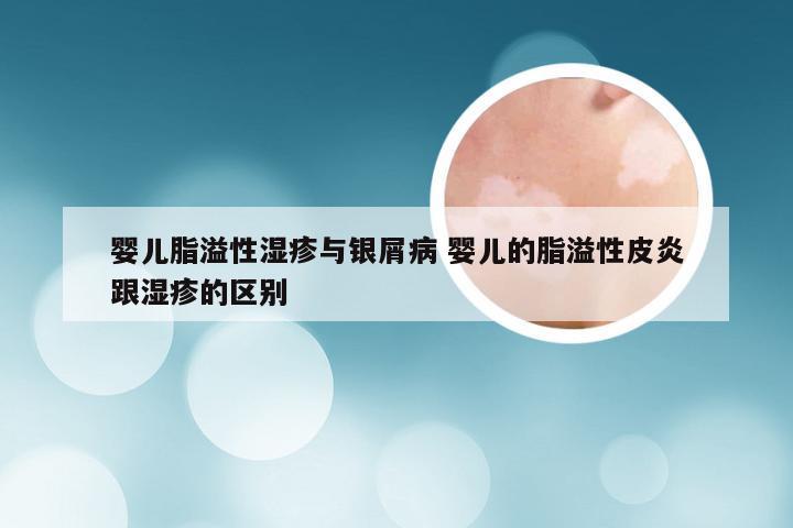 婴儿脂溢性湿疹与银屑病 婴儿的脂溢性皮炎跟湿疹的区别