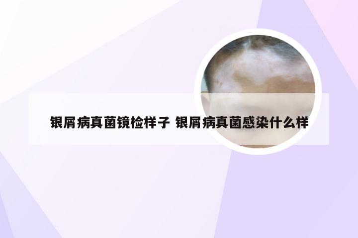 银屑病真菌镜检样子 银屑病真菌感染什么样