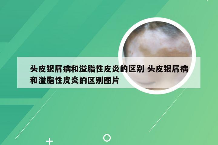 头皮银屑病和溢脂性皮炎的区别 头皮银屑病和溢脂性皮炎的区别图片