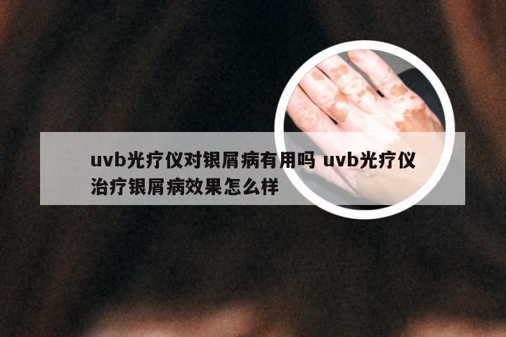 uvb光疗仪对银屑病有用吗 uvb光疗仪治疗银屑病效果怎么样