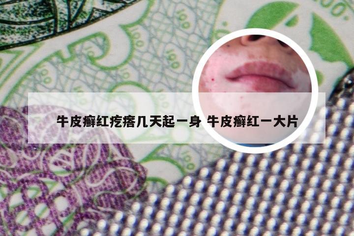 牛皮癣红疙瘩几天起一身 牛皮癣红一大片