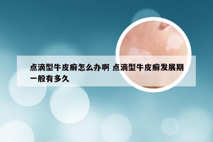 点滴型牛皮癣怎么办啊 点滴型牛皮癣发展期一般有多久